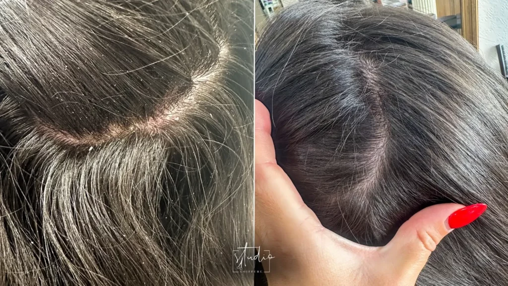 Pellicules cheveux causes solutions