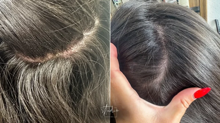 Pellicules cheveux causes solutions