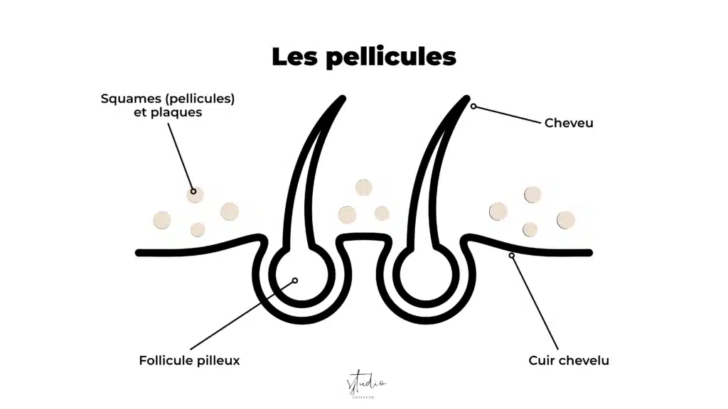 Pellicules cheveux schéma squames cuir chevelu